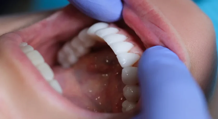 Can You Get a Cavity With Dental Veneers?