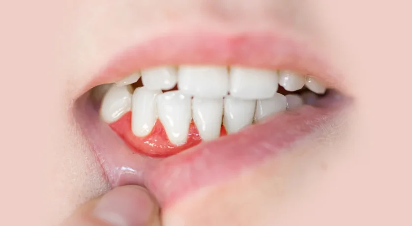 Periodontal Treatment Needed By Most People Globally Is Accepted Only By A Few