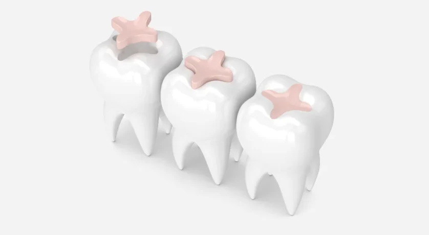 Can Sealants Be Placed Over Fillings?